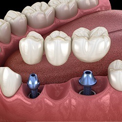 Diagram of implant bridge in Park City