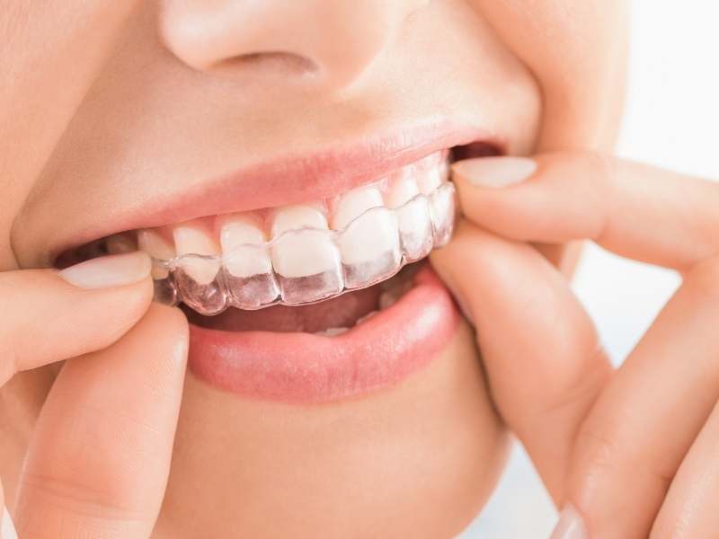 Nightguards before placement