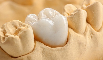 Model smile with dental crown restoration