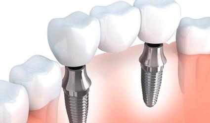 An implant-retained bridge.
