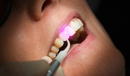Closeup of smile during laser dentistry treatment