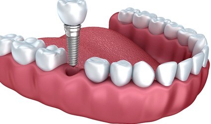 Illustration of dental implant and crown being placed in lower arch